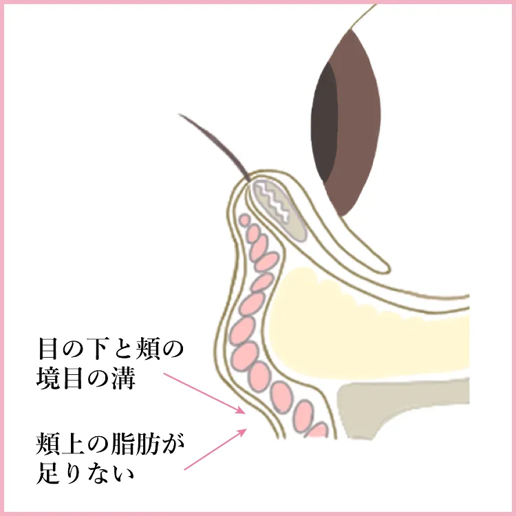 施術方法 脱脂＋脂肪注入 説明1 美容外科 美容皮膚科 木田ビューティークリニック 大阪 心斎橋