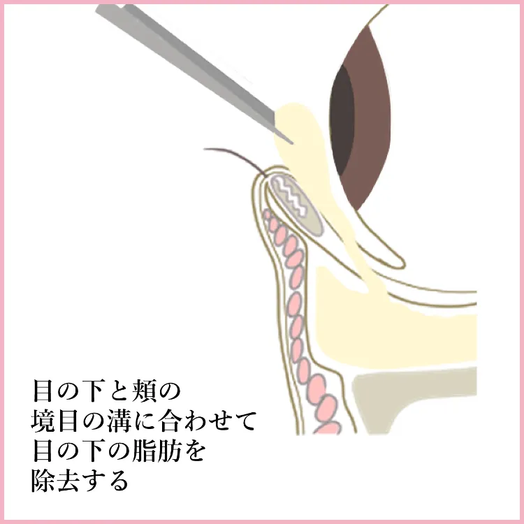 施術方法 脱脂＋脂肪注入 説明2 美容外科 美容皮膚科 木田ビューティークリニック 大阪 心斎橋