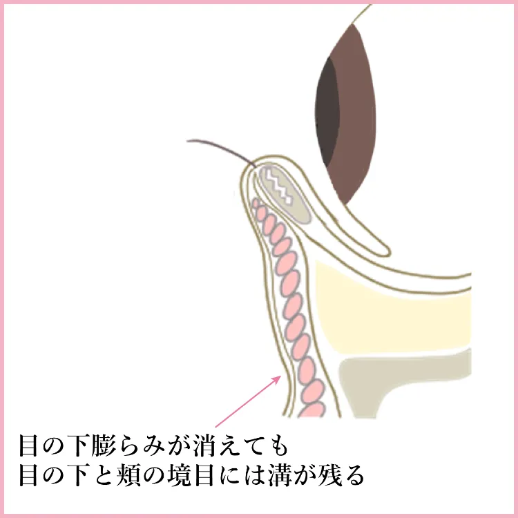 施術方法 脱脂＋脂肪注入 説明3 美容外科 美容皮膚科 木田ビューティークリニック 大阪 心斎橋