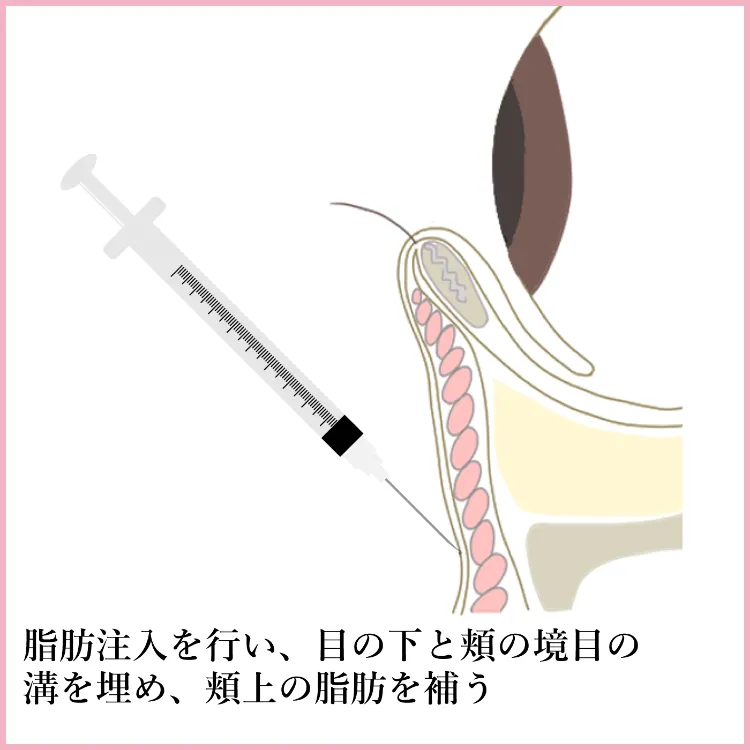 施術方法 脱脂＋脂肪注入 説明4 美容外科 美容皮膚科 木田ビューティークリニック 大阪 心斎橋