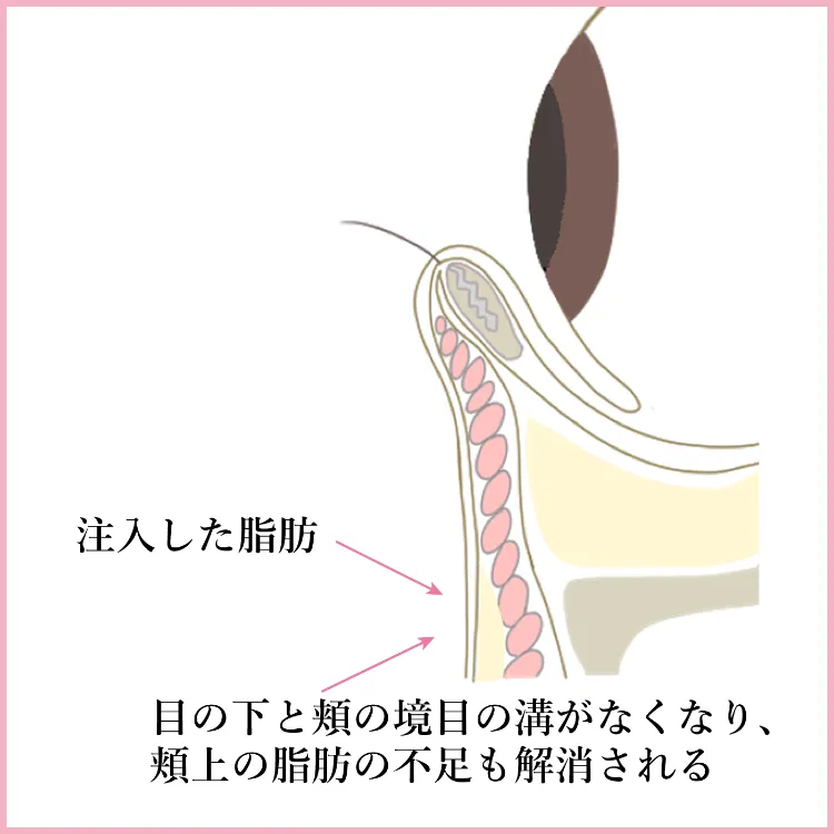 施術方法 脱脂＋脂肪注入 説明5 美容外科 美容皮膚科 木田ビューティークリニック 大阪 心斎橋